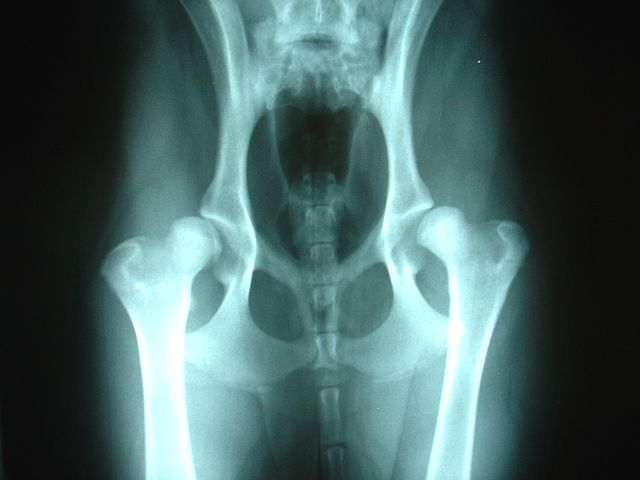 A Guide to Hip Dysplasia